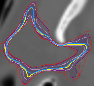 Contour boxplot that provides a statistical summary of an ensemble of contours of a slice of the right parotid gland of a head-and-neck cancer patient.