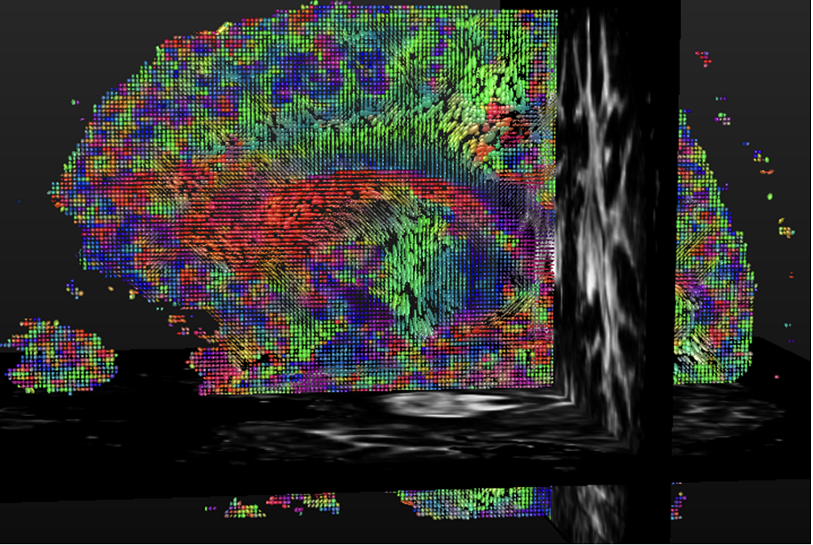 Saggital view of DT ellipsoids generated for a healthy Human Brain