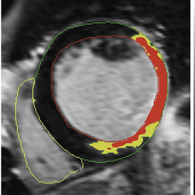 The preprocessing steps. Left Definition of the contours, Middle Definition of scar (gray zone (in yellow) and core zone (in red)) and Right The composition of the mesh based on the contours in 3D. The last described preprocessing step of indicating the position of the origin of the left main coronary artery is not included in this figure