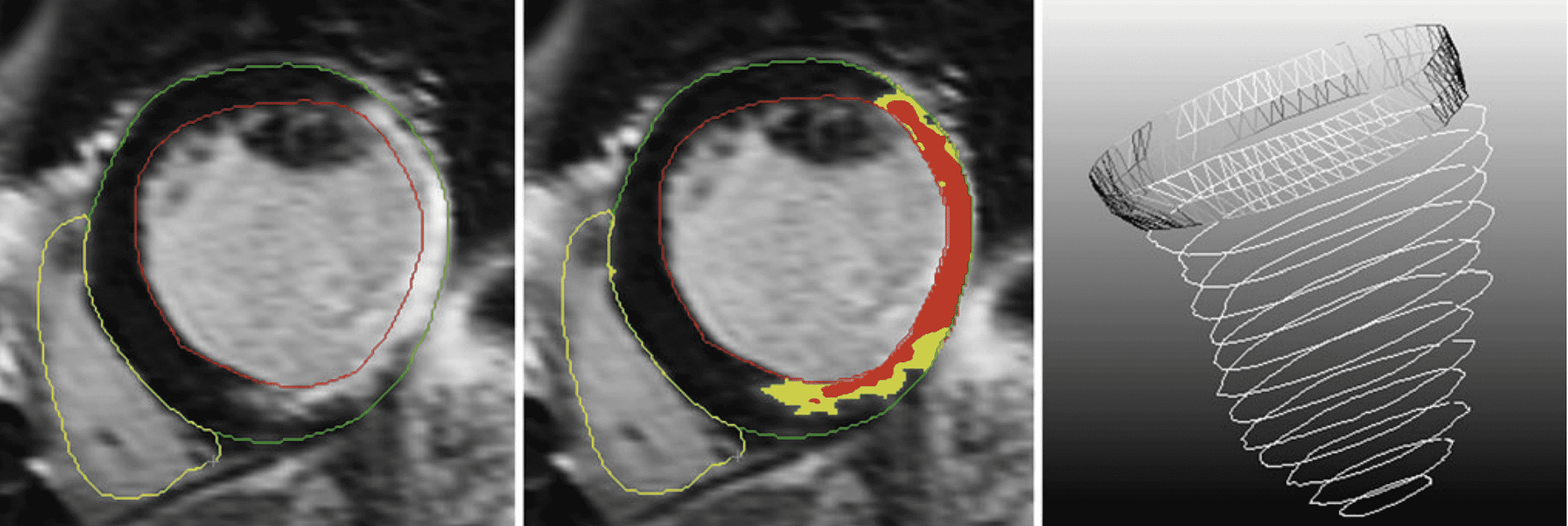 The preprocessing steps. Left Definition of the contours, Middle Definition of scar (gray zone (in yellow) and core zone (in red)) and Right The composition of the mesh based on the contours in 3D. The last described preprocessing step of indicating the position of the origin of the left main coronary artery is not included in this figure
