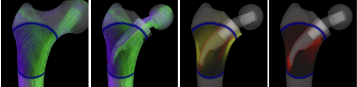 Interactive visualizations of simulated stress tensor fields for a human femur under load