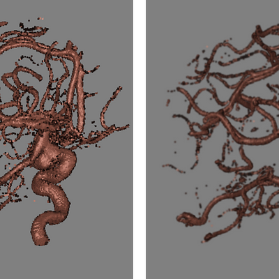 ShellSplat rendering of rotational b-plane x-ray scan of the arteries of the right half of a human head, showing an aneurism. On the left is the fast rendering and on the right is the high quality version. Data from volvis.org courtesy of Philips Research, Hamburg, Germany.