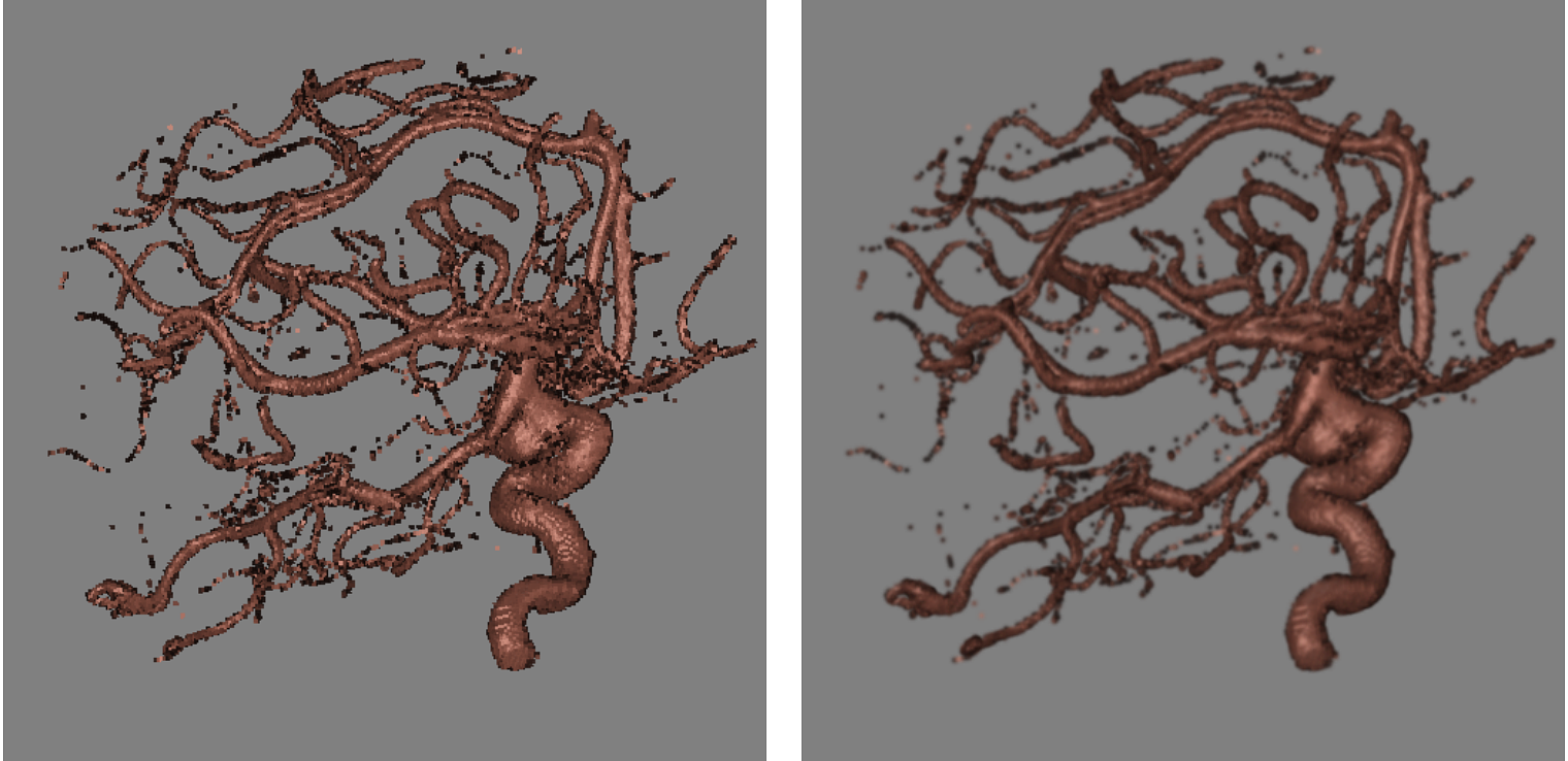 ShellSplat rendering of rotational b-plane x-ray scan of the arteries of the right half of a human head, showing an aneurism. On the left is the fast rendering and on the right is the high quality version. Data from volvis.org courtesy of Philips Research, Hamburg, Germany.