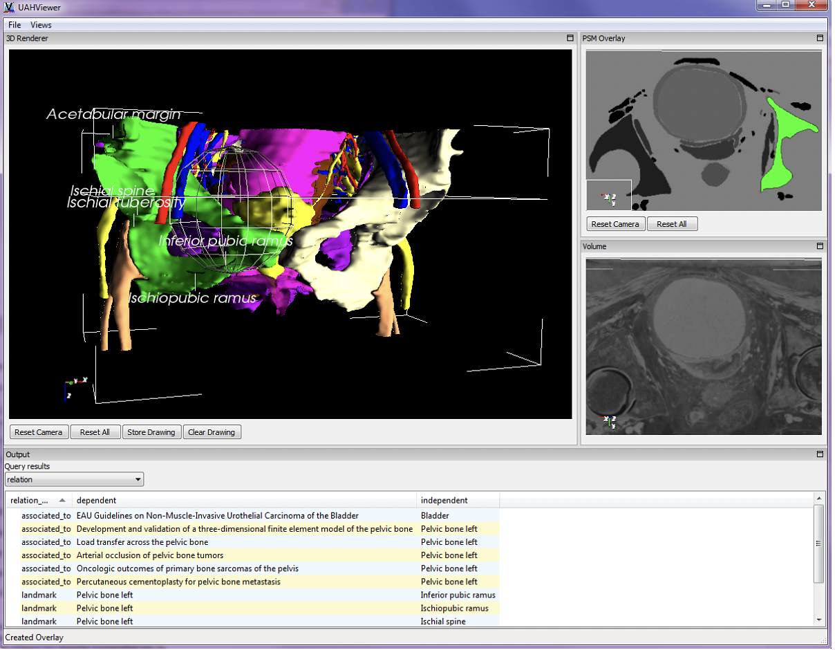 Spatial querying through sphere selection. A distance query reveals the literature and anatomical landmarks associated to the structures within the selection sphere.