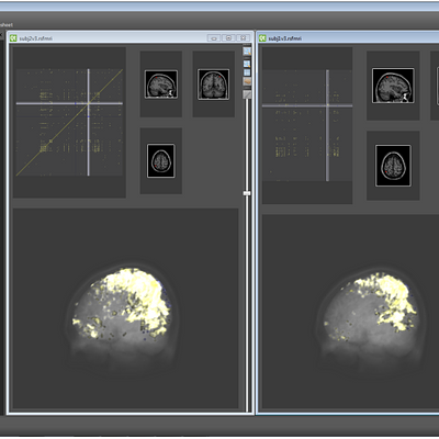 An overview of the application window with two datasets. Each dataset is opened in its own child window. Each child window contains of three views: the pixmap view on the top-left, the slice views on the top right and the anatomical view on the bottom.