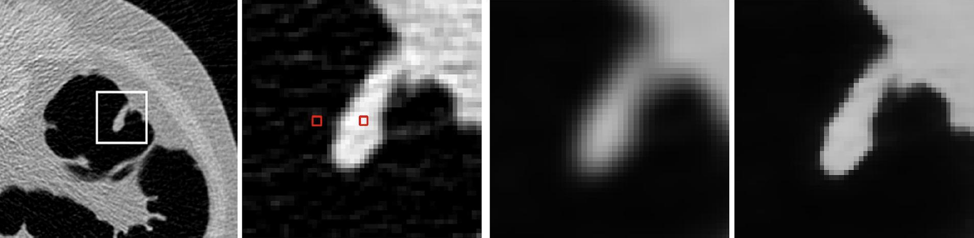 From left to right: Axial slice with boxed polyp; enlarged polyp, squares denote two locations, the left one is in air and the right one inside the polyp; Gaussian filtered result (σ =2.0 mm); Bilateral filtered result (σ dis = 3.0 mm and σ int = 250 HU)