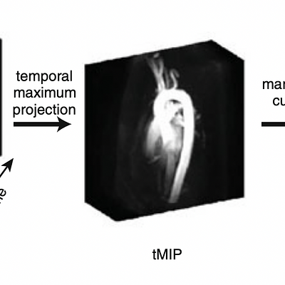A temporal maximum speed volume (tMSV) takes the maximum blood-flow speed for each voxel throughout the cardiac cycle. An initial surface can be extracted from this static representation of the blood-flow regions. A standard marching cubes algorithm is employed to generate the iso-surface