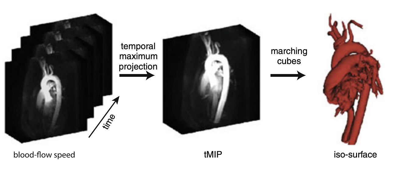 A temporal maximum speed volume (tMSV) takes the maximum blood-flow speed for each voxel throughout the cardiac cycle. An initial surface can be extracted from this static representation of the blood-flow regions. A standard marching cubes algorithm is employed to generate the iso-surface
