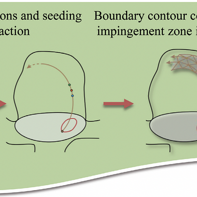 Overview of the extraction approach: Based on the flow grid and the aneurysm ostium we seed streamlines at the ostium into the aneurysm. We identify several local line properties on the streamlines to compute a quality scalar field on the ostium. Given this scalar field we extract a seeding curve on the ostium, which is used to construct the boundary contour of the inflow jet. A second scalar field is computed on the aneurysm surface to indicate the impingement zone. Finally, we visualize both information expressively.
