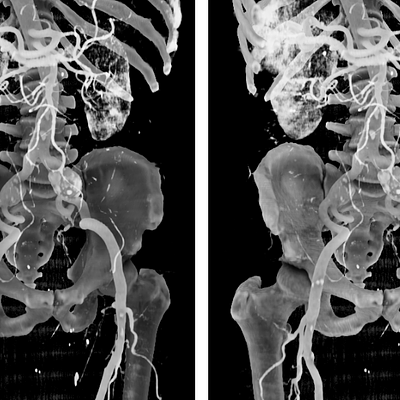 Effect of the normal factor