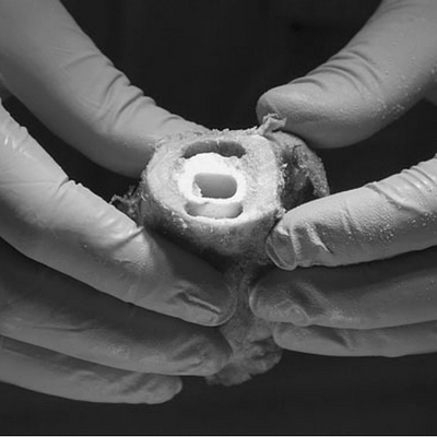 Femoral lesions mechanically created anterior and posterior of the cement mantle are shown with the prosthesis removed