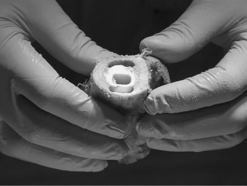 Femoral lesions mechanically created anterior and posterior of the cement mantle are shown with the prosthesis removed