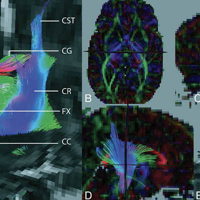 3D FT superimposed on 2D ADC maps. A, Whole-brain FT results, in a preterm infant at TEA. View from the front left. B, Definition of PLIC ROIs. View from the top (on the axial plane). ROIs superimposed on an FA-weighted color map. C, Definition of CC ROIs. View from the left (on the sagittal plane). ROIs superimposed on an FA-weighted color map. D, PLIC fiber bundle. View from the right (on the sagittal plane). ROIs superimposed on an FA-weighted color map. E, CC fiber bundle. View from the front left (on the sagittal plane). ROIs superimposed on an ADC map. CST indicates the corticospinal tract; CR, the corona radiata; FX, the fornix; CG, the cingulum