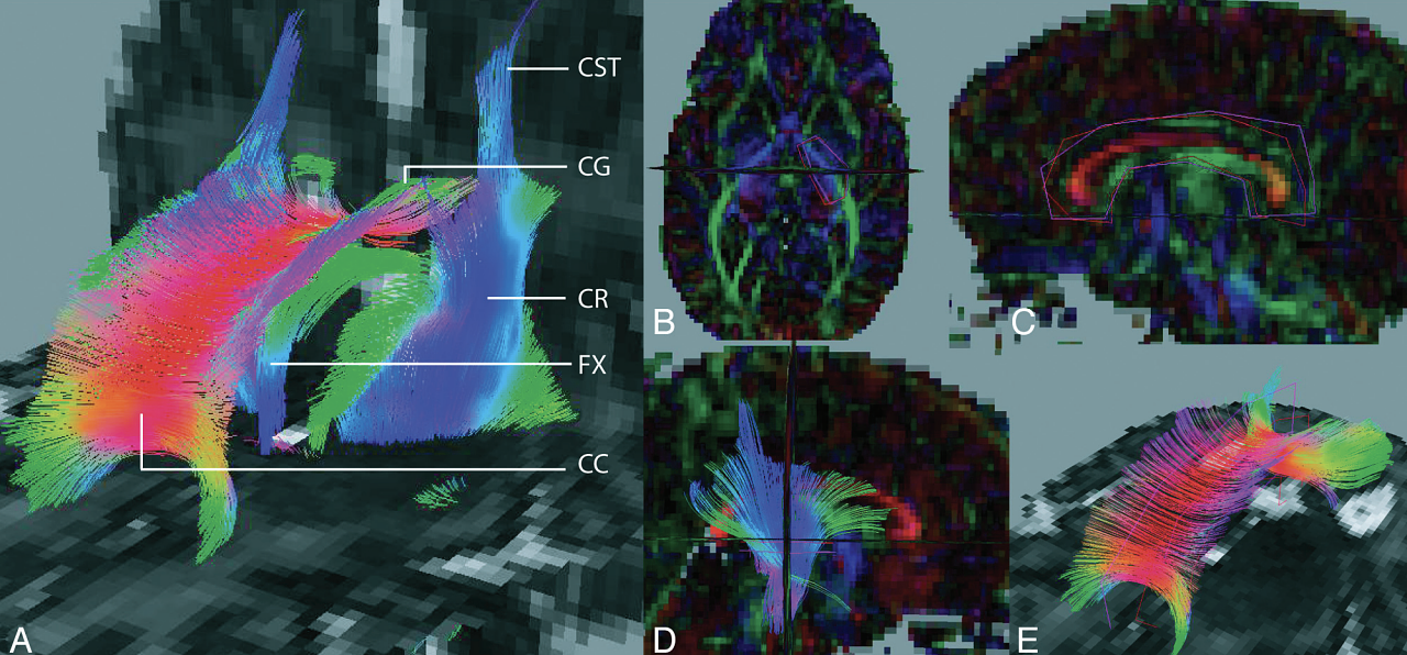 3D FT superimposed on 2D ADC maps. A, Whole-brain FT results, in a preterm infant at TEA. View from the front left. B, Definition of PLIC ROIs. View from the top (on the axial plane). ROIs superimposed on an FA-weighted color map. C, Definition of CC ROIs. View from the left (on the sagittal plane). ROIs superimposed on an FA-weighted color map. D, PLIC fiber bundle. View from the right (on the sagittal plane). ROIs superimposed on an FA-weighted color map. E, CC fiber bundle. View from the front left (on the sagittal plane). ROIs superimposed on an ADC map. CST indicates the corticospinal tract; CR, the corona radiata; FX, the fornix; CG, the cingulum