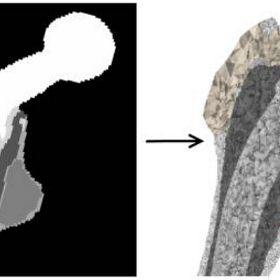 Orthopaedic workflow for hip prosthesis replacement: A 3D CT-scan (a) is segmented into labels (b). This discrete volume image is converted to a volume mesh (c). Based on medical simulations (d) [1], optimal implant design and positioning can be determined.