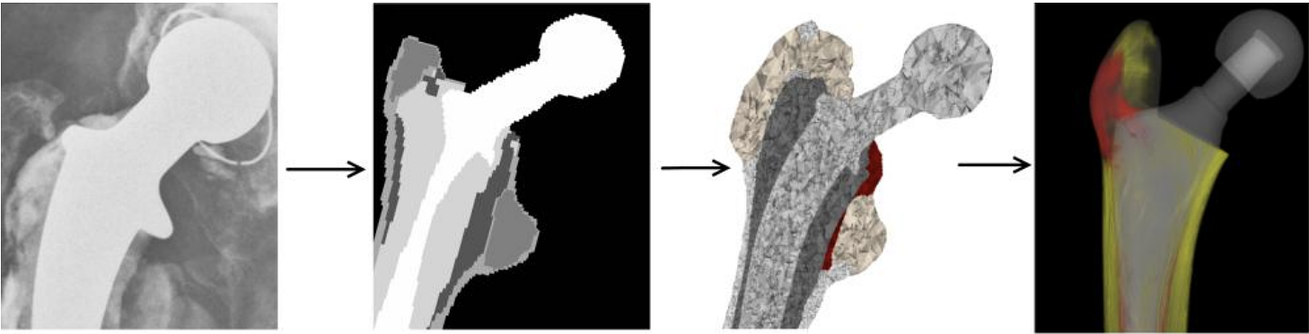 Orthopaedic workflow for hip prosthesis replacement: A 3D CT-scan (a) is segmented into labels (b). This discrete volume image is converted to a volume mesh (c). Based on medical simulations (d) [1], optimal implant design and positioning can be determined.