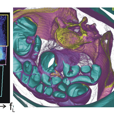 Abdominal CT scan