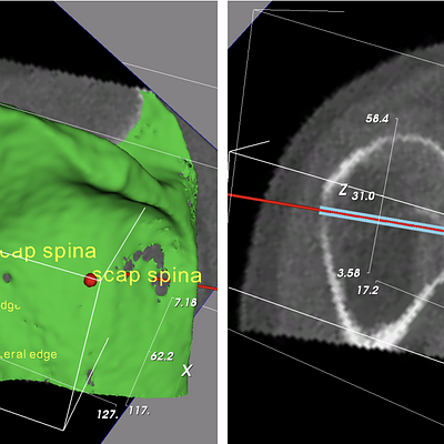 Part of the glenoid component planning functionality