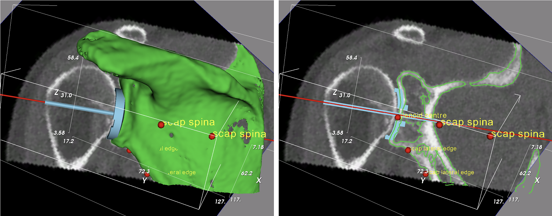 Part of the glenoid component planning functionality