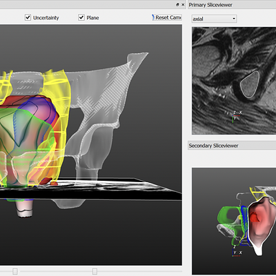 The PelVis prototype application featuring the 3D model on the left and a linked MRI and unfolded view visualization on the right