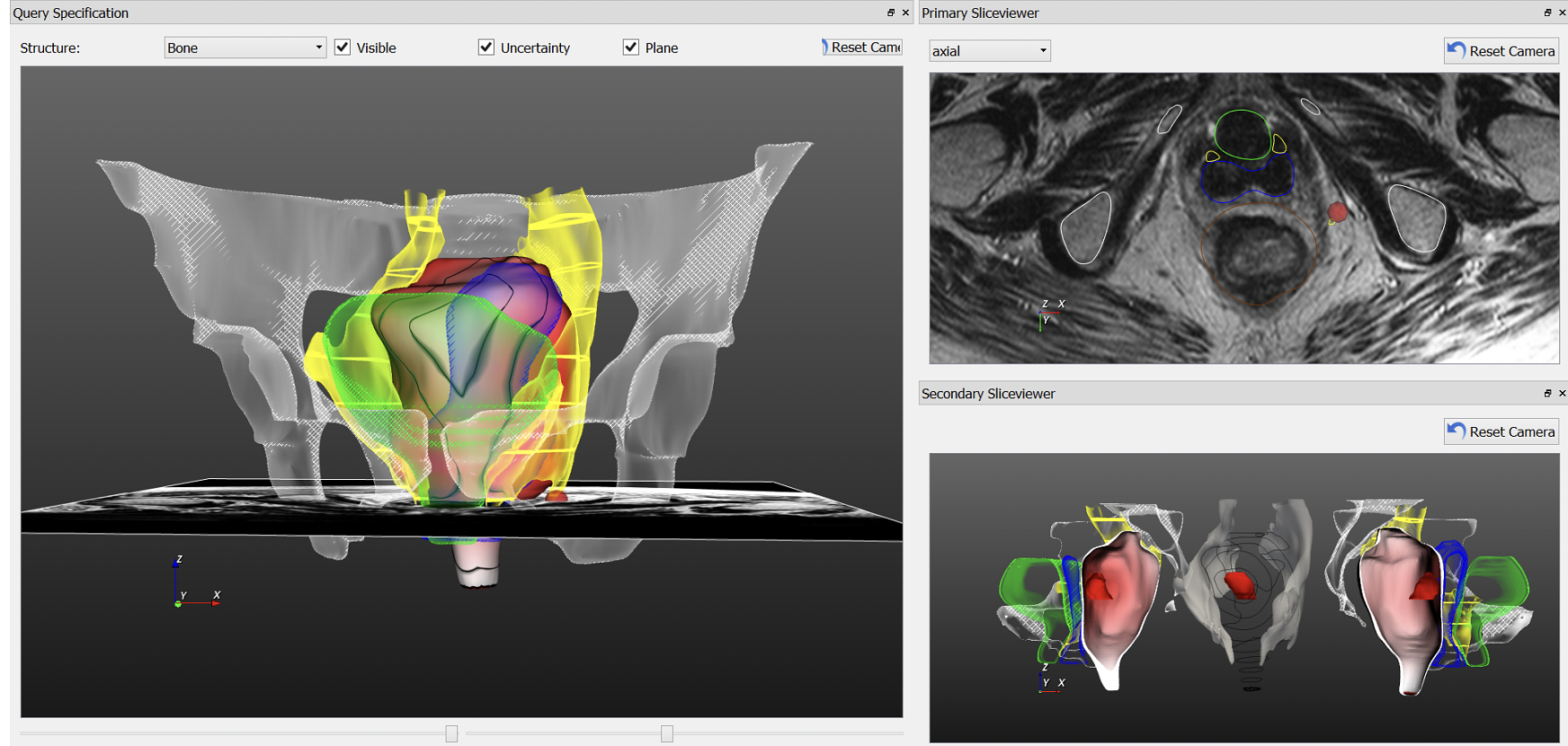 The PelVis prototype application featuring the 3D model on the left and a linked MRI and unfolded view visualization on the right