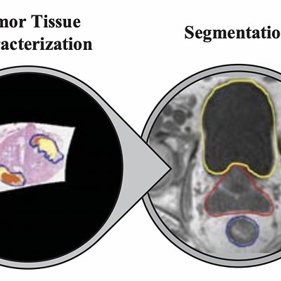 Schematic depiction of the steps of the patient-specific radiotherapy planning pipeline, employed in clinical research to create personalized, tumor-tailored radiotherapy plans.