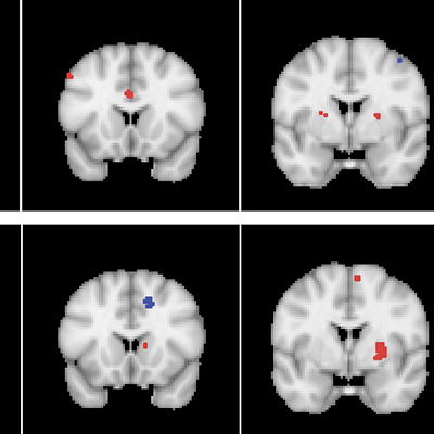 Significant functional connectivity clusters for (a) the right and (b) the left atlas-based STN ROIs, shown on three coronal slices of the MNI152 template. The yellow lines on the axial image on the left-hand side show the position of the coronal slices. Red clusters exhibit positive regression coefficients, while blue clusters yield negative coefficients