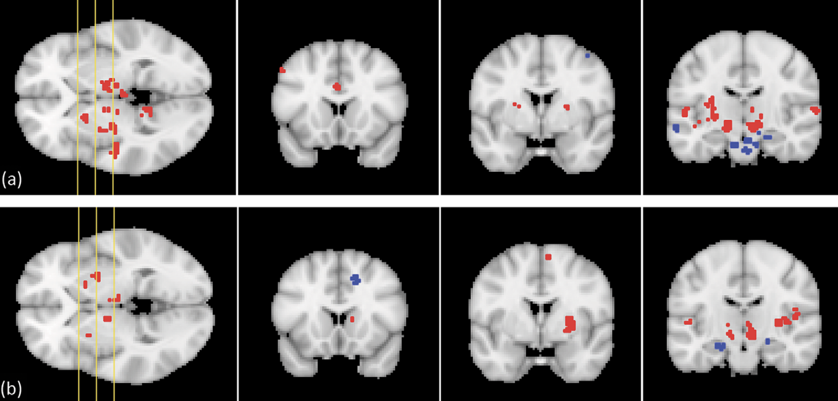 Significant functional connectivity clusters for (a) the right and (b) the left atlas-based STN ROIs, shown on three coronal slices of the MNI152 template. The yellow lines on the axial image on the left-hand side show the position of the coronal slices. Red clusters exhibit positive regression coefficients, while blue clusters yield negative coefficients