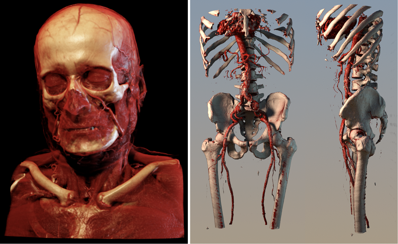 Two examples of interactive visualizations made with the volume renderer of Kroes et al. 