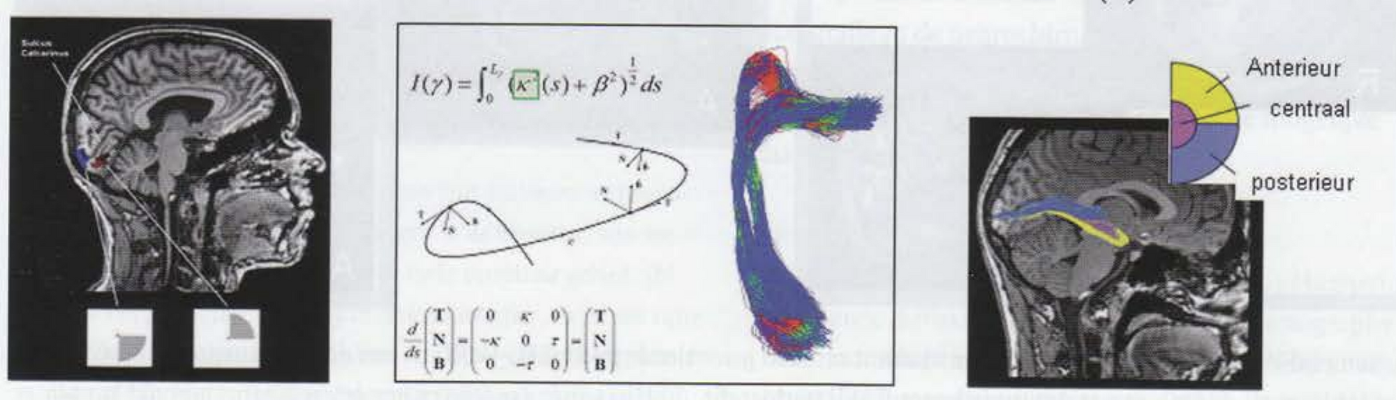 Voorspellen van visueel functieverlies door epilepsiechirurgie