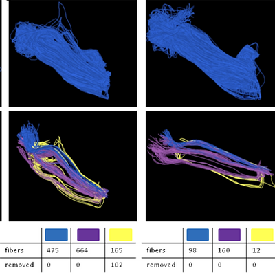 Result of fiber tracking using three seedpoints based on the activity maps