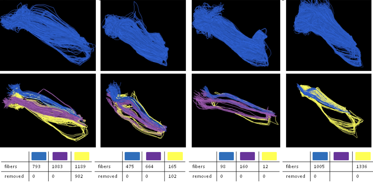 Result of fiber tracking using three seedpoints based on the activity maps