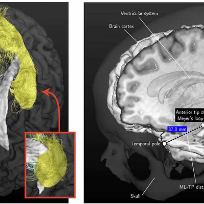 Left: An example of the reconstruction result of the OR using probabilistic tractography from an axial view. As inserts, close-ups are shown of the anterior tips of the reconstructions of the OR from a coronal view. Right: The tracking results are shown for the same volunteer in a composite image along with other brain structures such as the ventricular system. The ML-TP distance measurement is indicated.