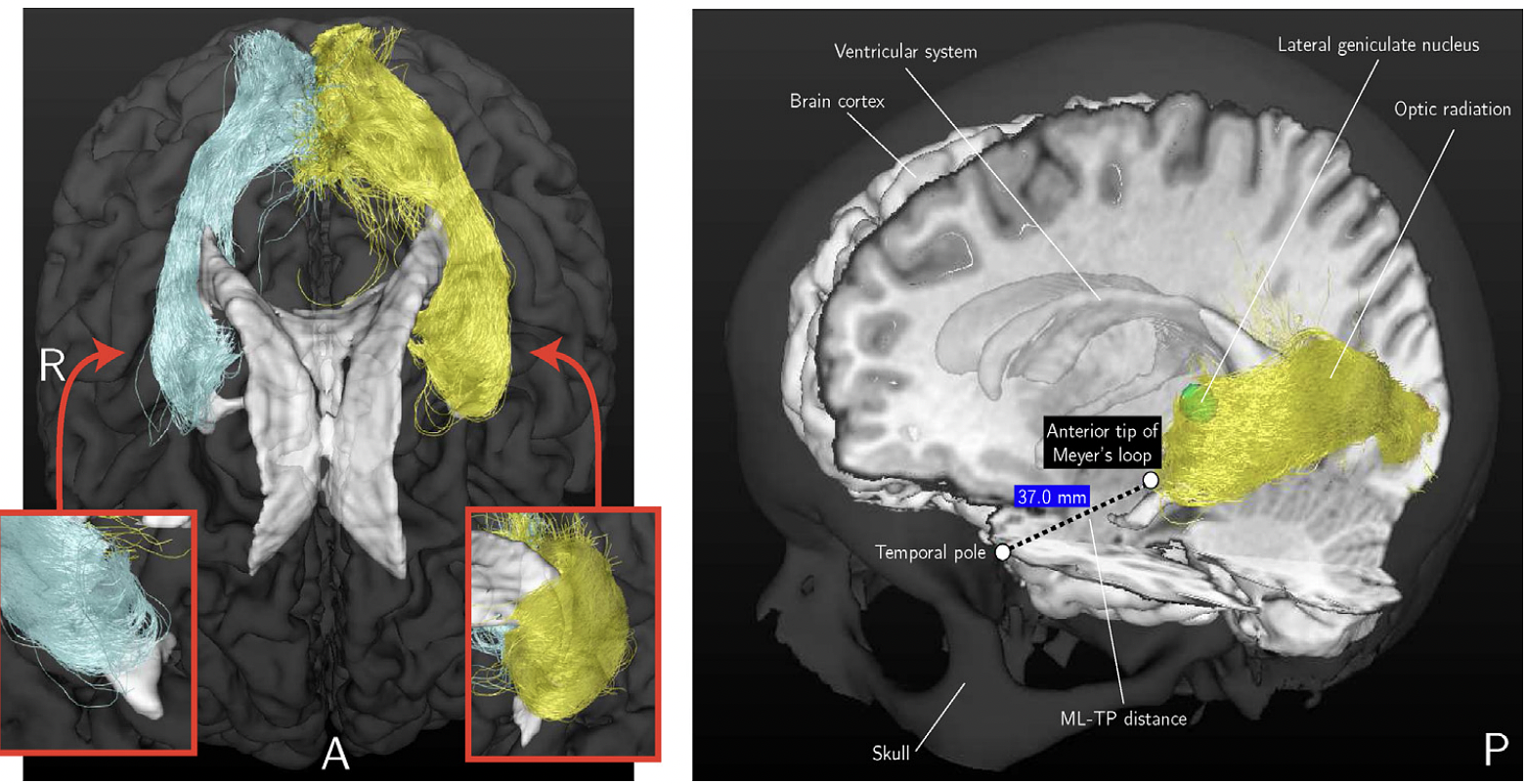 Left: An example of the reconstruction result of the OR using probabilistic tractography from an axial view. As inserts, close-ups are shown of the anterior tips of the reconstructions of the OR from a coronal view. Right: The tracking results are shown for the same volunteer in a composite image along with other brain structures such as the ventricular system. The ML-TP distance measurement is indicated.