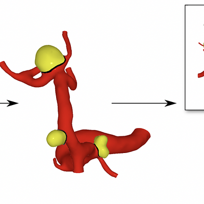 From an input mesh representing the surface of a vessel, our algorithm detects and segments the aneurysms in the vessel. Afterwards, a report is generated including meta information on the patient as well as summaries of characteristics of the aneurysms, e.g., their widths and heights.