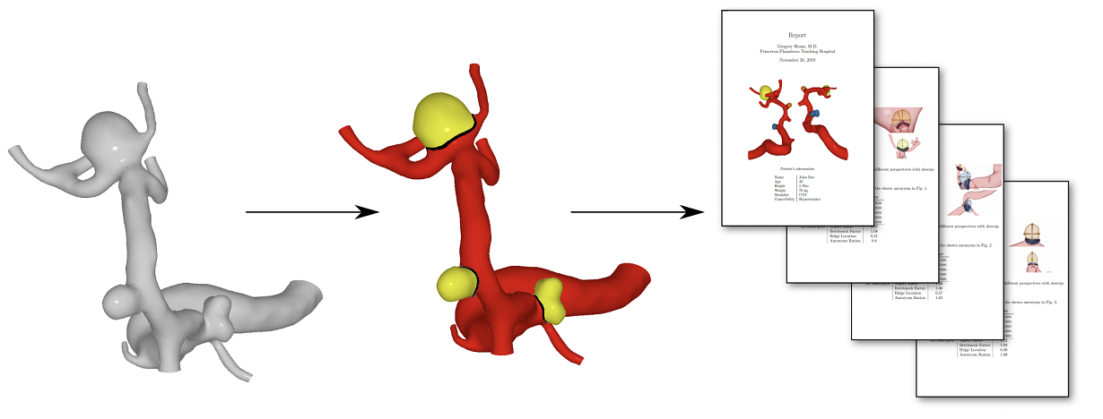From an input mesh representing the surface of a vessel, our algorithm detects and segments the aneurysms in the vessel. Afterwards, a report is generated including meta information on the patient as well as summaries of characteristics of the aneurysms, e.g., their widths and heights.