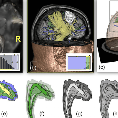 (a) Optic radiation, (b) pyramidal tract with tumor, (c) uncertainty lens, (d–i) different visual styles applied to optic radiation (warm-to-cool outlines, warm-to-cool surfaces, decreasing opacity, light-to-dark, increasing dilation, increasing blur)