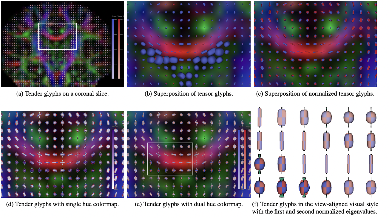 The application of the Tender glyphs to compare two DTI datasets acquired with different b-values.