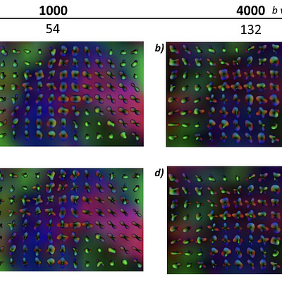 In vivo results of the brain area of  corpus callosum and corona radiate.
