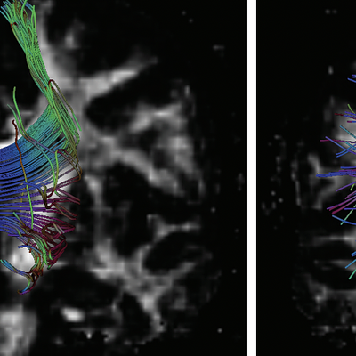 Fiber-tracking results for the corpus callosum, using stream-line (a) or geodesics via the raytracing method (b).