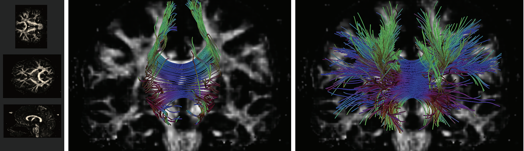 Fiber-tracking results for the corpus callosum, using stream-line (a) or geodesics via the raytracing method (b).
