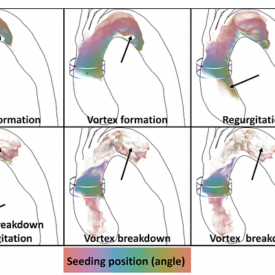 Streak visualization showing the formation, shedding and breakdown of a vortex in a patient with an aortic dissection in the aortic arch and regurgitation is present in the ascending aorta. The corresponding video can be found in the supporting material.