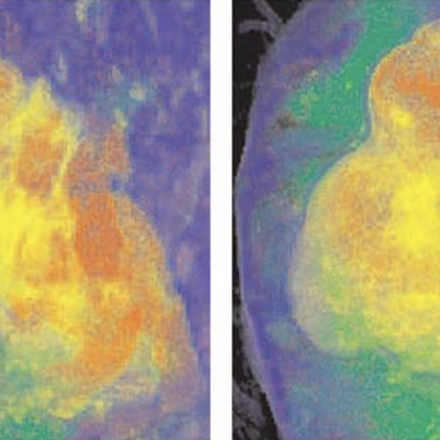 Two frames of a real-time animation sequence that conveys the uncertainty regarding the border between a cyst and a hemorrhage in an MR brain examination 