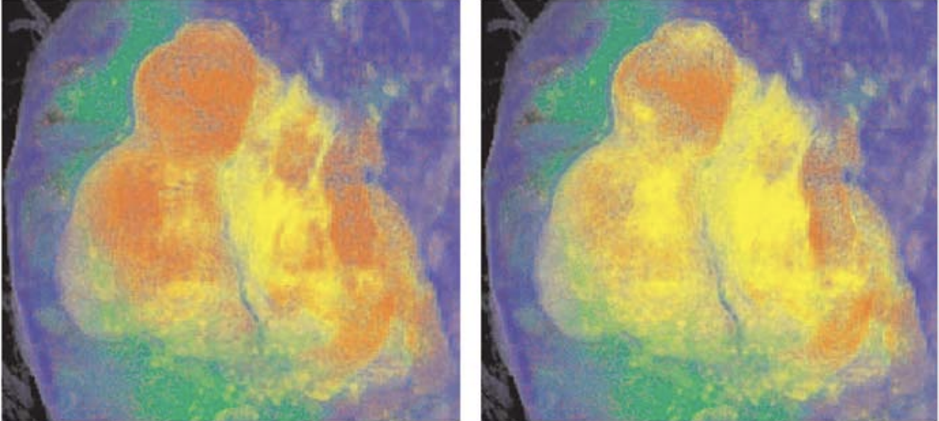 Two frames of a real-time animation sequence that conveys the uncertainty regarding the border between a cyst and a hemorrhage in an MR brain examination 