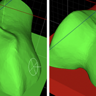 Left full exposure, pins can be deployed anywhere on the bone/cartilage. Right limited exposure. The orthopedic surgeon paints the areas on the bone that are deemed accessible during surgery, thus limiting where pins can be deployed