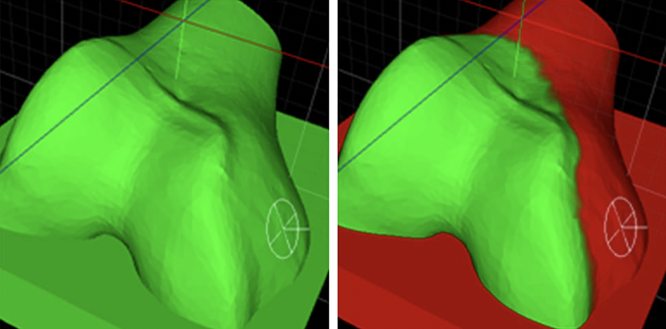 Left full exposure, pins can be deployed anywhere on the bone/cartilage. Right limited exposure. The orthopedic surgeon paints the areas on the bone that are deemed accessible during surgery, thus limiting where pins can be deployed