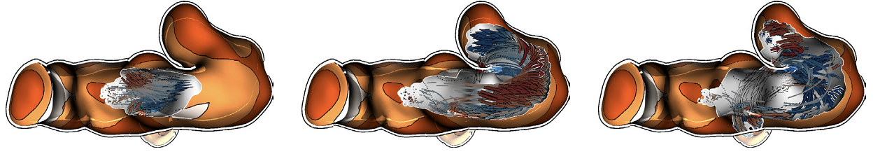 Three subsequent time steps of the animated pathlines in a vessel. The cutaway technique facilitates insight into the vessel during the animation of the blood flow. Furthermore, arrow glyphs represent the flow’s pathlines.