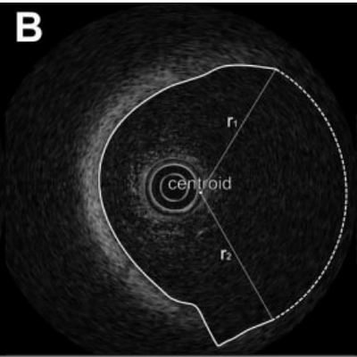  To close the remaining gaps, the straight line at the right-hand side (A), a circular arc interpolation is performed automatically using the center of gravity of the contour as the center of the circle (B). For the radius, linear interpolation is used from r1 to r2. The repaired contour is presented in (C)