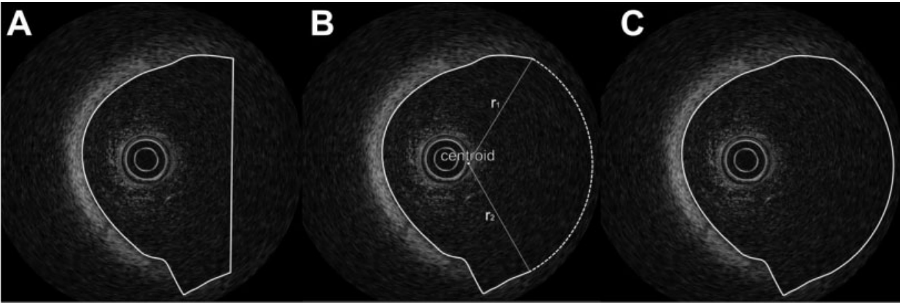  To close the remaining gaps, the straight line at the right-hand side (A), a circular arc interpolation is performed automatically using the center of gravity of the contour as the center of the circle (B). For the radius, linear interpolation is used from r1 to r2. The repaired contour is presented in (C)