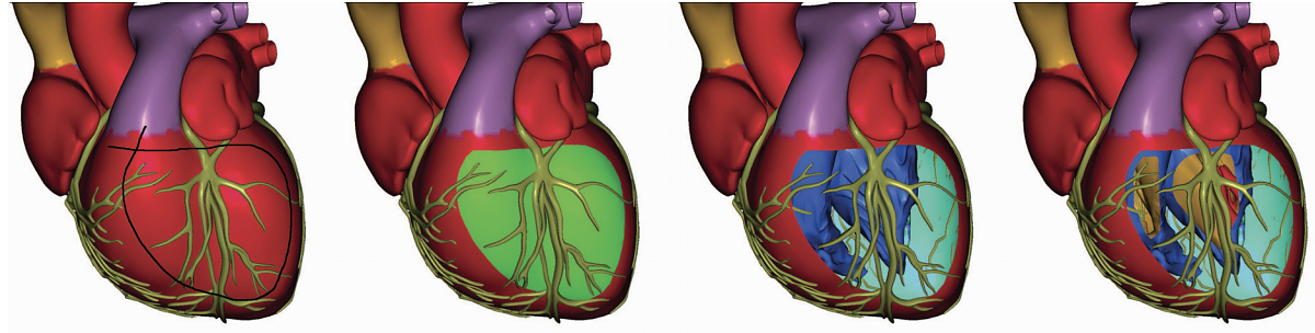 Occlusion-aware cutaway generation. From left to right: User-drawn curve, selected region (shaded green), cutout revealing interior, final illustration using consecutive cutaways.